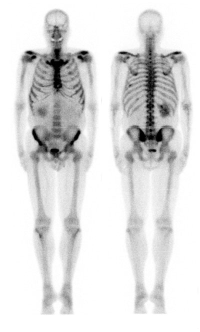 bone_scan.jpg